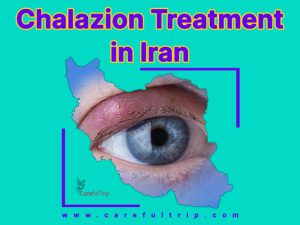 Chalazion treatment in Iran in 2022