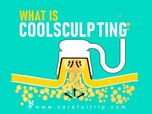 What is CoolSculpting?